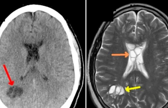У 52-річного американця в мозку завівся стрічковий черв’як через недосмажений бекон